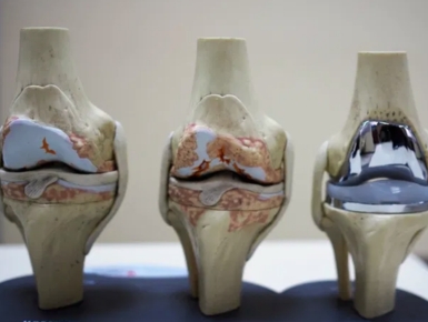 Joint Replacement
